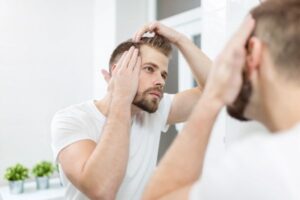 Minoxidil oral; imagen donde se muestra a un hombre preocupado por la apresurada pérdida de cabello