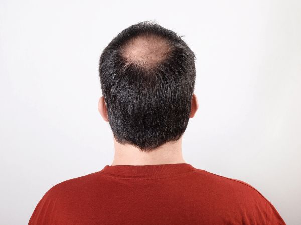 Minoxidil oral; imagen de hombre mostrando el área de su cabeza afectada por la alopecia